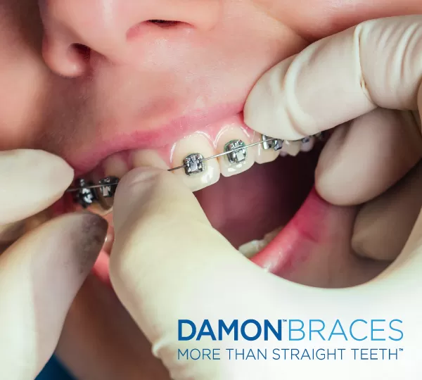 damon braces