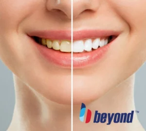 teeth whitening before after