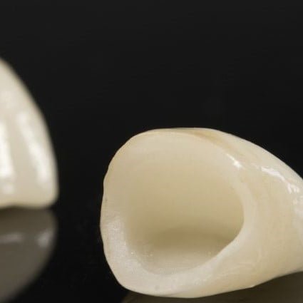 dental crowns min 925x425 1