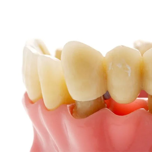 feature image 750x500 dental bridges
