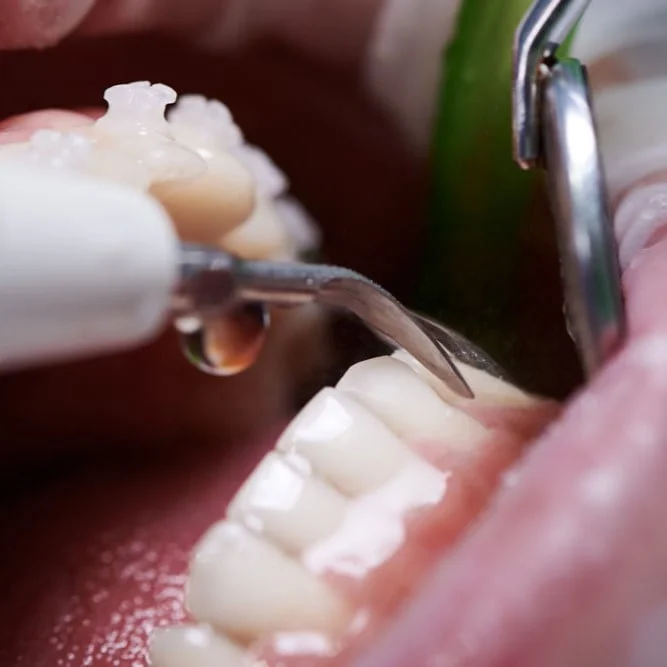 tratamiento Gingivitis vera almeria