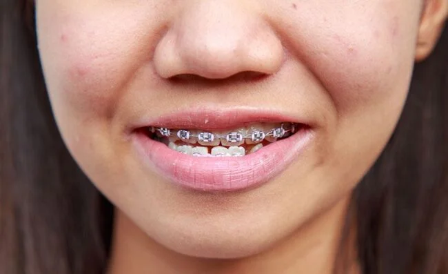Braces 3 Prognathism 650x397 1