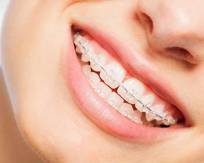 ceramic braces