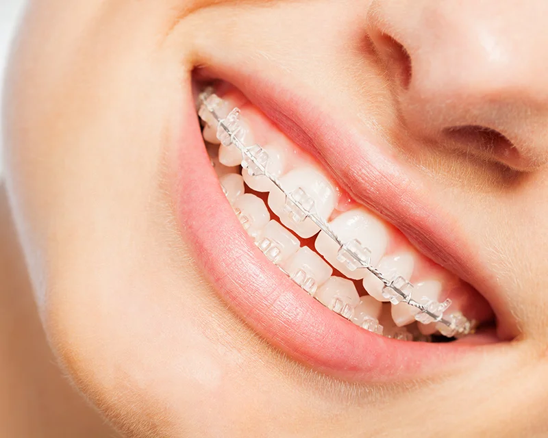 Conventional Braces 1 ceramic braces