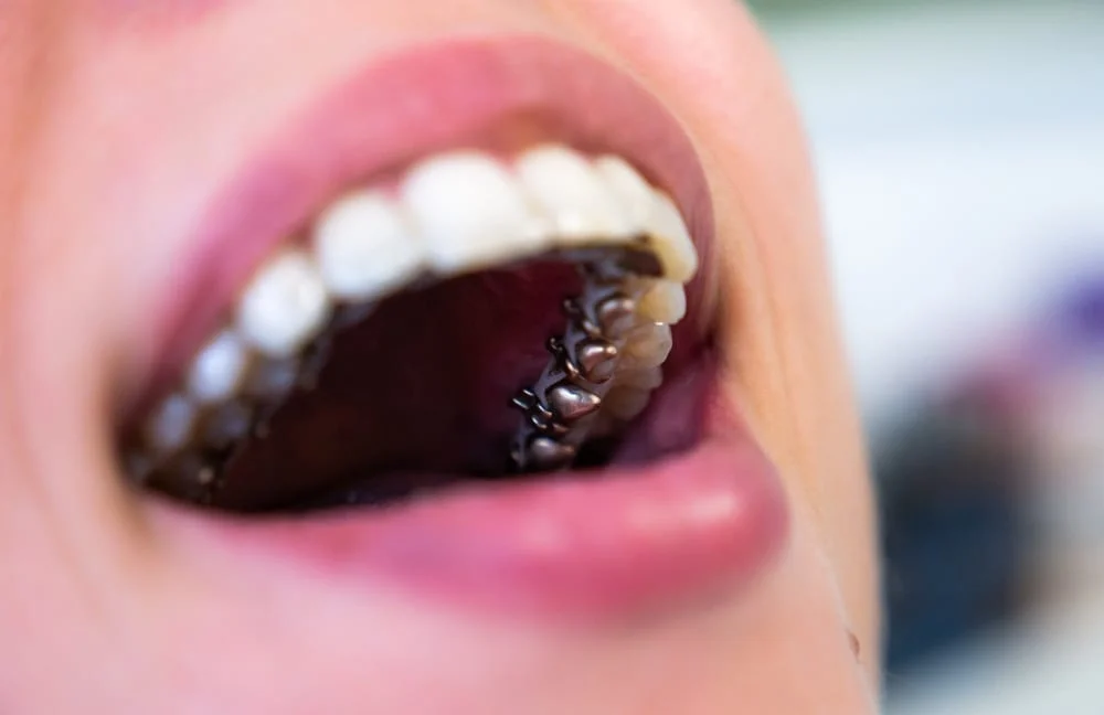 Conventional Braces 2 shutterstock 1305039190 0