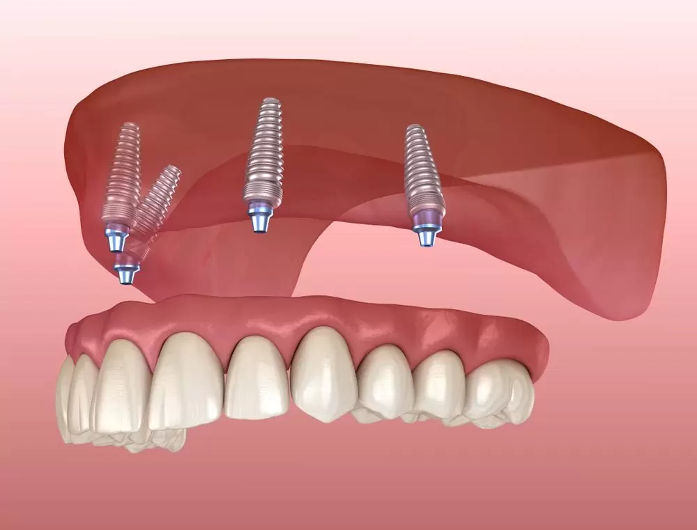 Dental Implants All On 4