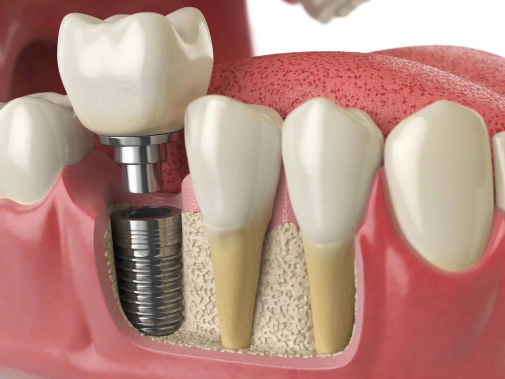 Pilih Jenis Implan Gigi Yang Paling Sesuai Untuk Gigi Depan atau Belakang 1 anatomy of healthy teeth and tooth dental implant P5PWYZQ