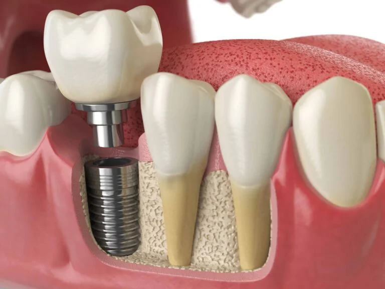 Minor Oral Surgery 3 anatomy of healthy teeth and tooth dental implant P5PWYZQ
