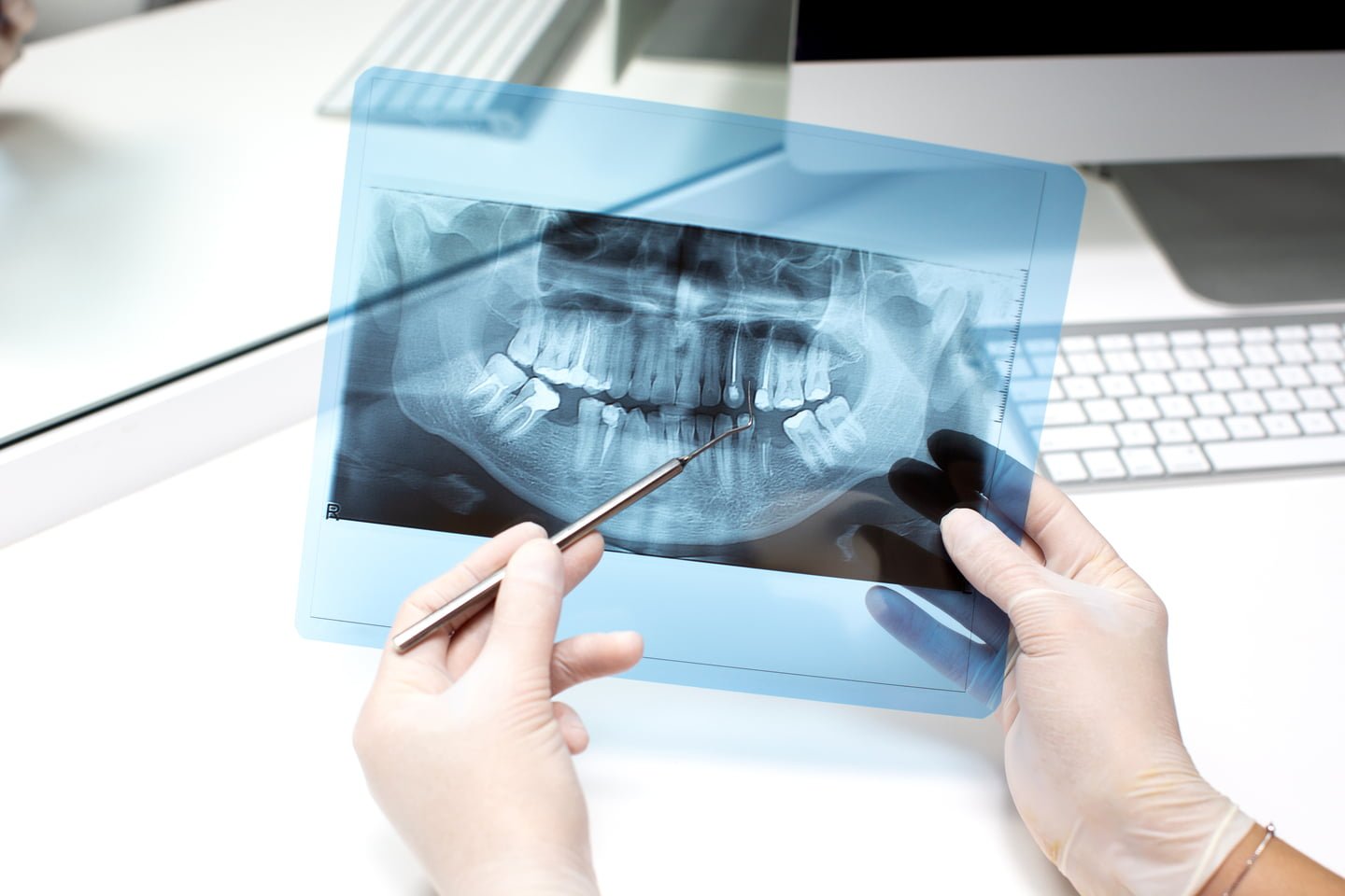 Treatment 14 dentist analyzes x ray photo