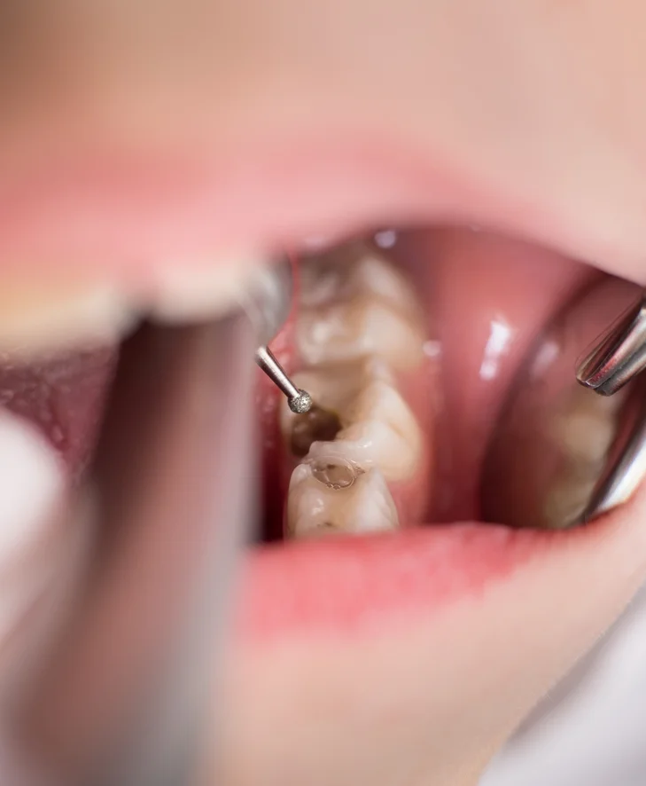 Minor Oral Surgery 2 boy with open mouth during drilling treatment at t 2023 11 27 05 20 24 utc