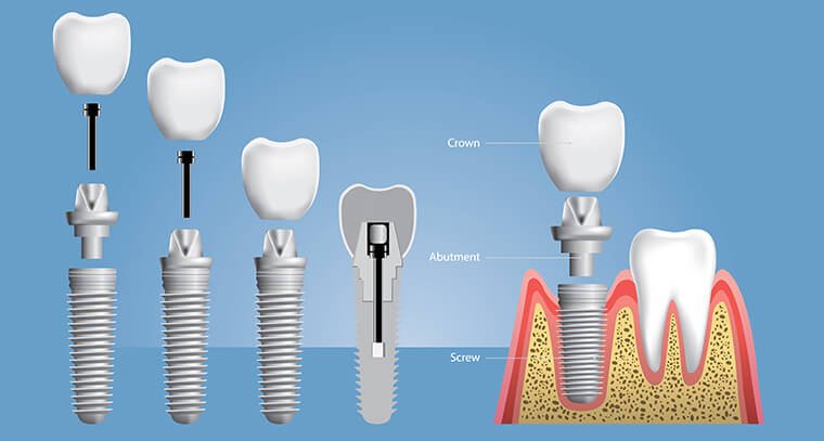 dental implant diagram