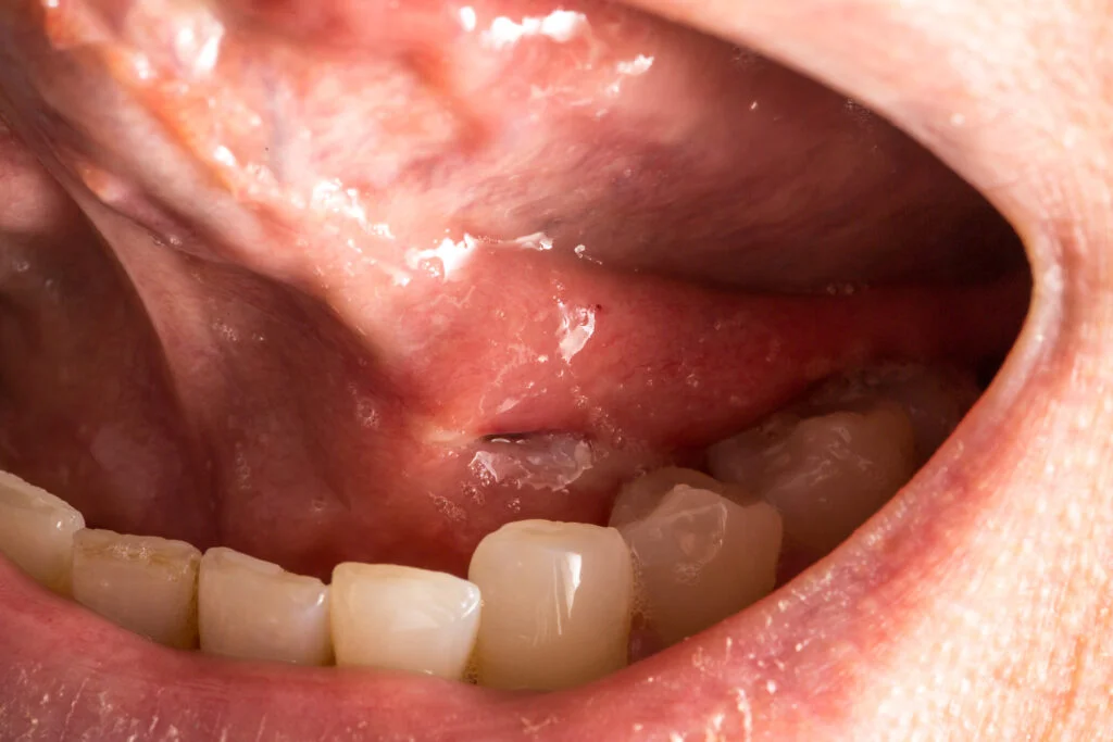 Minor Oral Surgery 5 macro of a woman s tongue seen from below showing 2023 11 27 05 14 38 utc