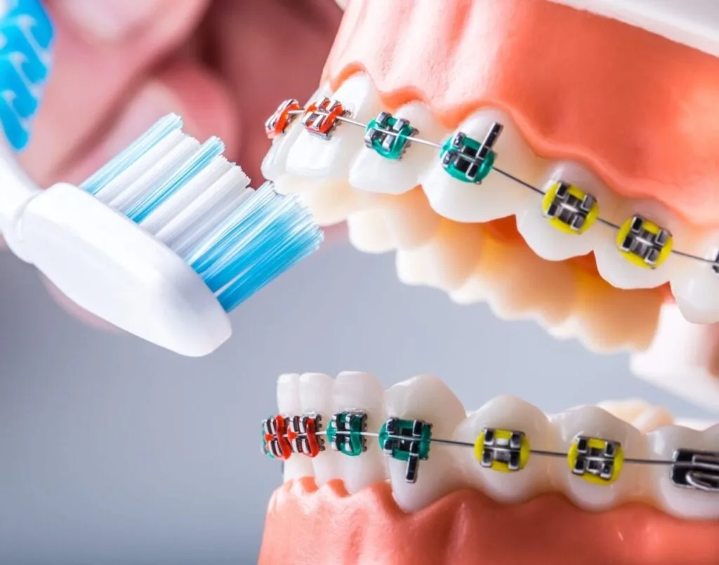 How to Tell if You Have a Cavity with Braces 1 cavity with braces