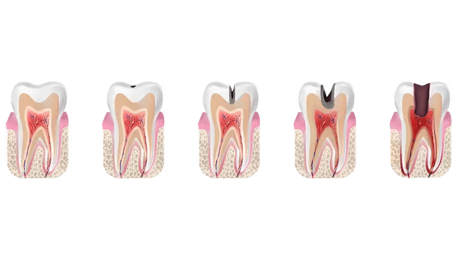 five stages of tooth decay