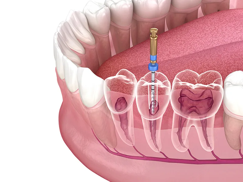 Gigi Goyang Boleh Diselamatkan Atau Kena Cabut? 2 Rawatan Akar (Root Canal) – Kalau Gigi Berlubang Dah Sampai Saraf