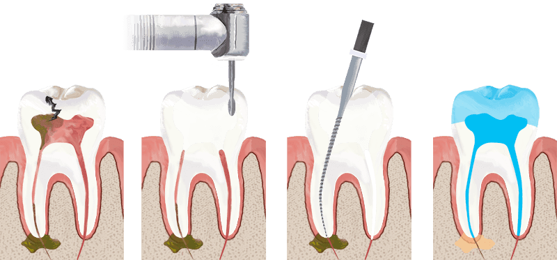 root canal