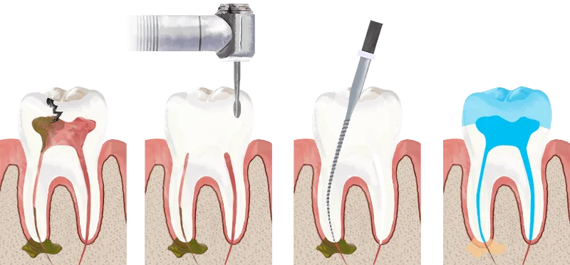 root canal