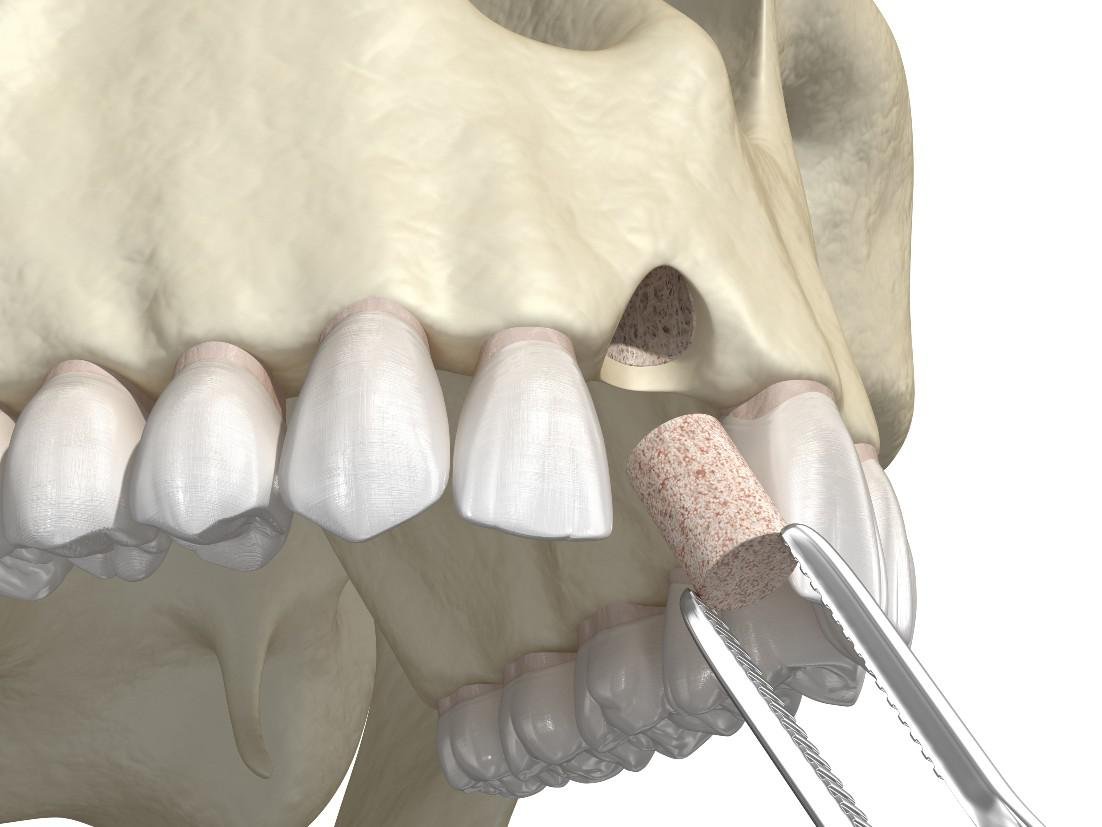 bone grafts