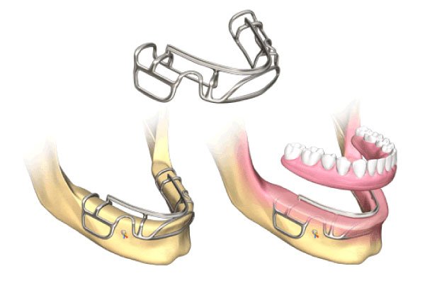 customized subperiosteal dental implants lynnwood