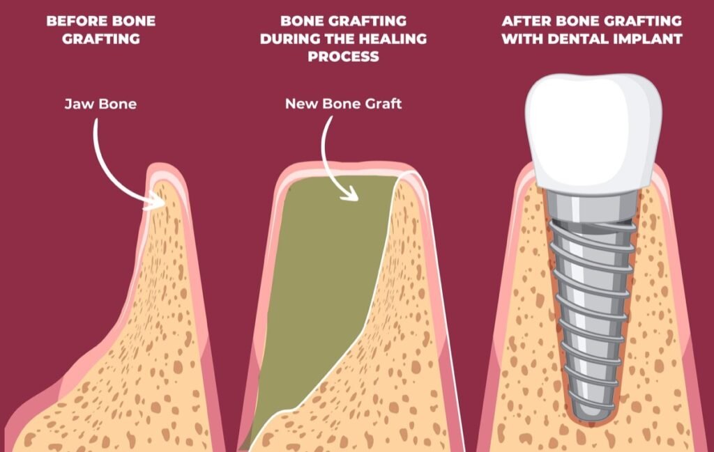 dental grafting min