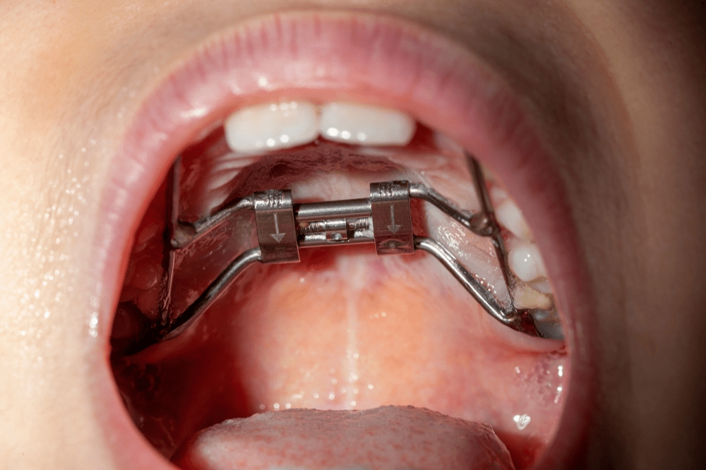 The Complete Guide to Orthodontic Palatal Expanders