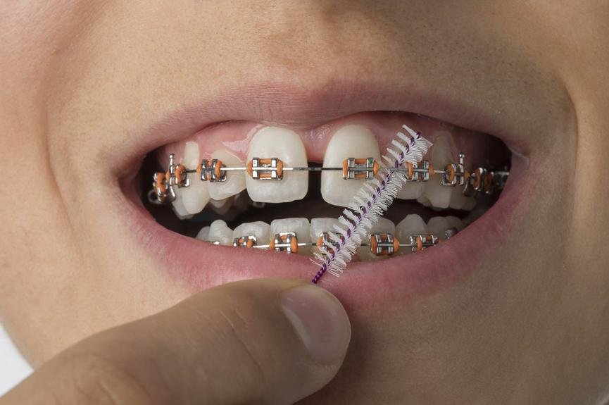 close up dental braces gap teeth diastema pgsbqvy