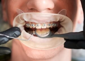 Do they remove teeth for braces? Yes, in most cases.