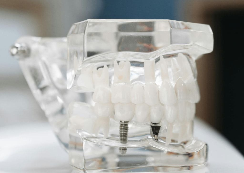 Dental implant costs in Malaysia compared to Thailand. Is it worth the hassle?