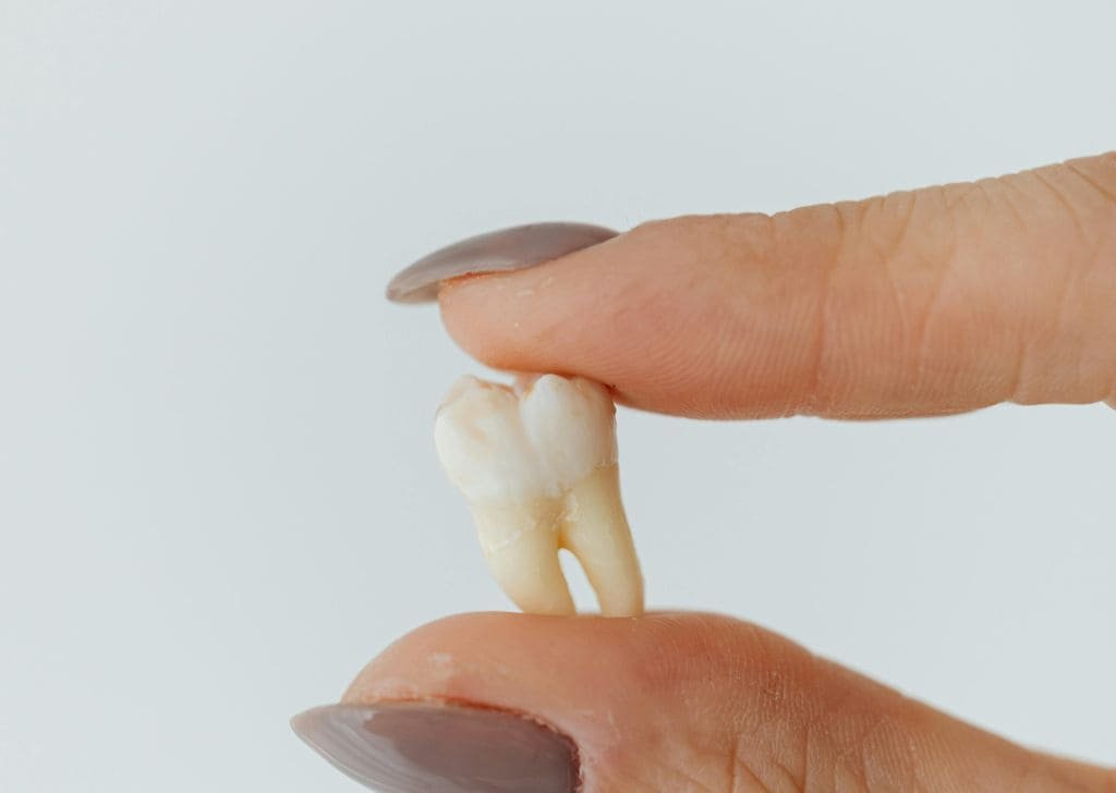 A removed tooth in a patient's hand.
