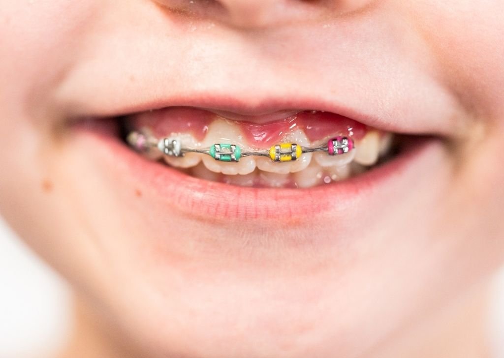 Choosing the colour of your braces isn’t just about aesthetics - it can actually change how your teeth look.