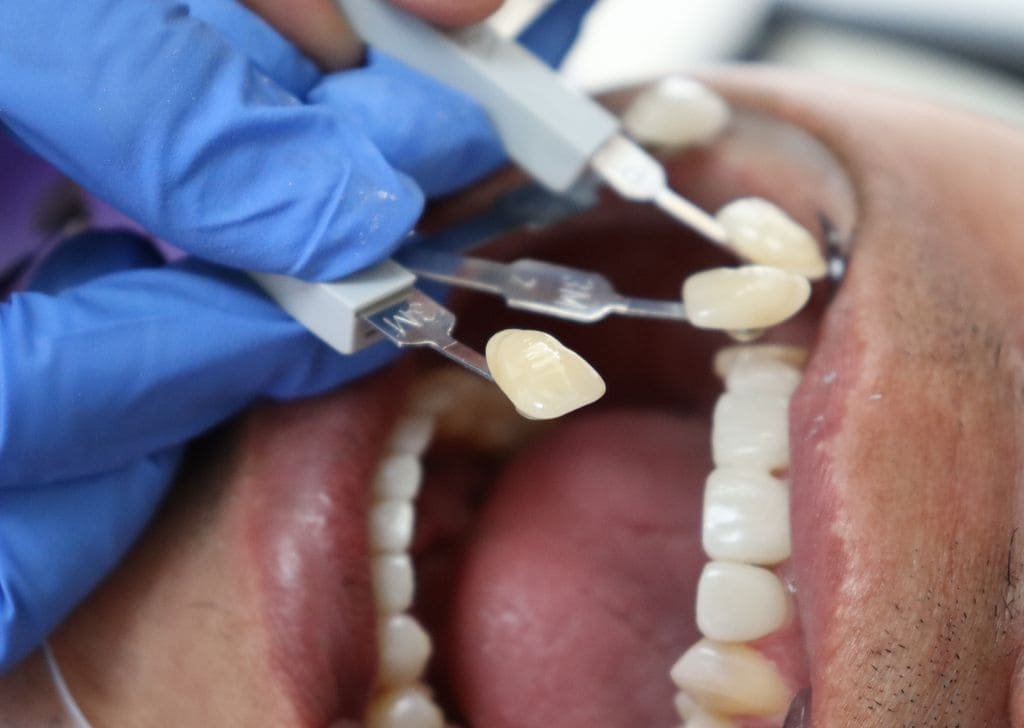 Masalah Gigi Yang Sesuai Untuk Veneer
