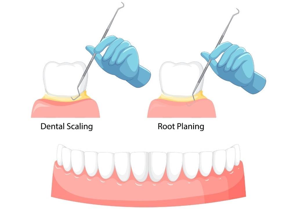 Scaling & Root Planing (Cuci Akar Gigi)