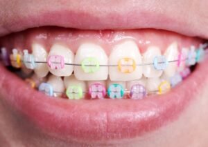 Are Colored Braces More Expensive?