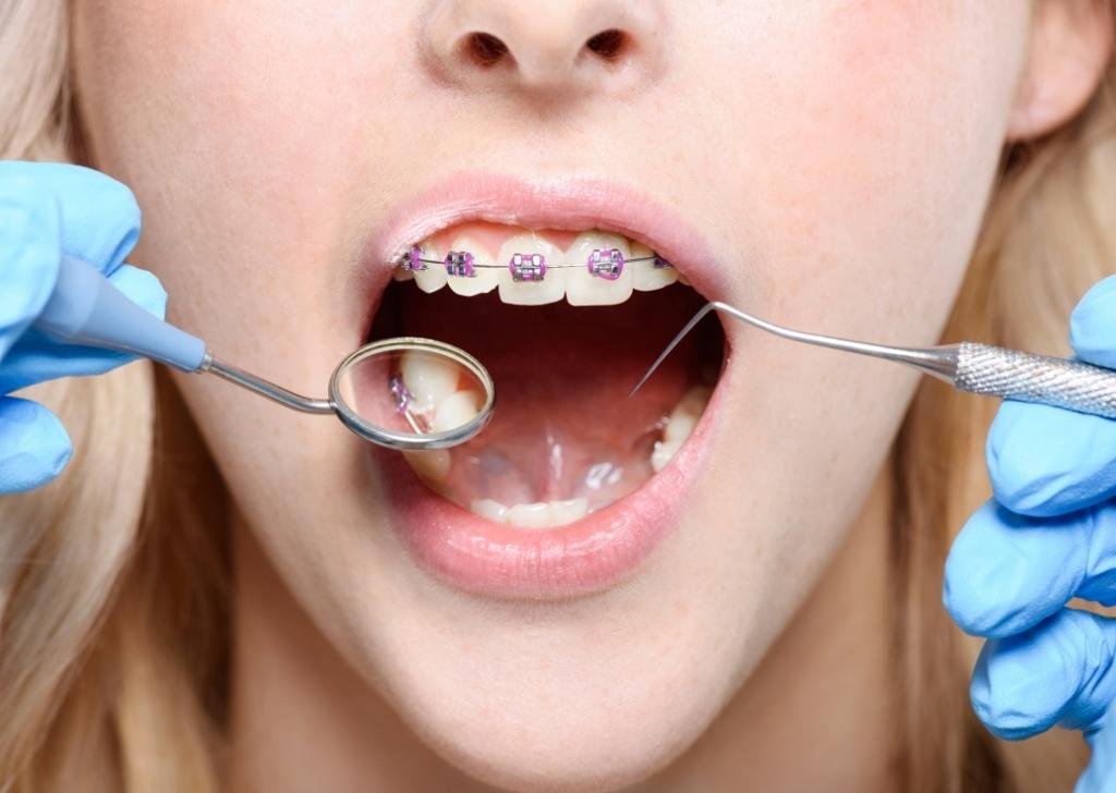 Do Colours Impact Orthodontic Treatment Results