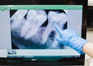Should you remove wisdom teeth before getting braces? Here’s what Penang dentists recommend based on your unique case.