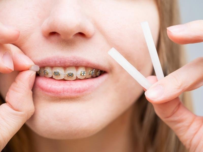 Can I Quickly Remove Braces Pain With Home Remedies? 6 If you feel your braces cutting into your cheek or causing ulcers, orthodontic wax is a lifesaver.
