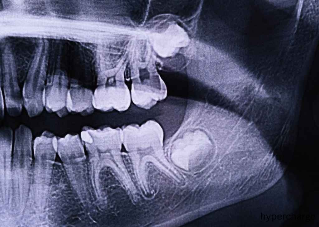 Wisdom teeth, also known as third molars, are the last set of permanent teeth to develop in the mouth.