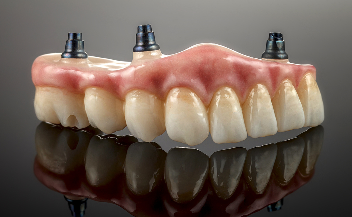 Gigi Palsu Implan