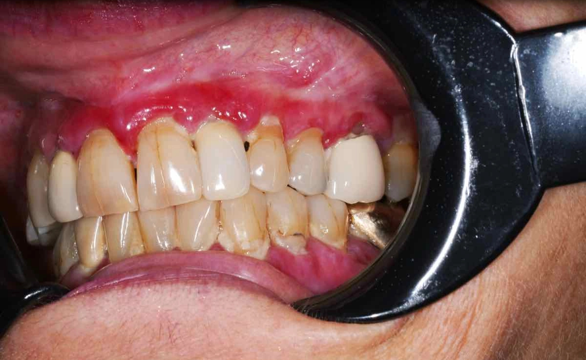 Upper Gum Infection