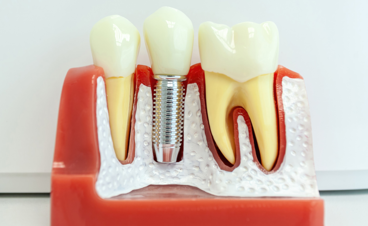 Implan gigi