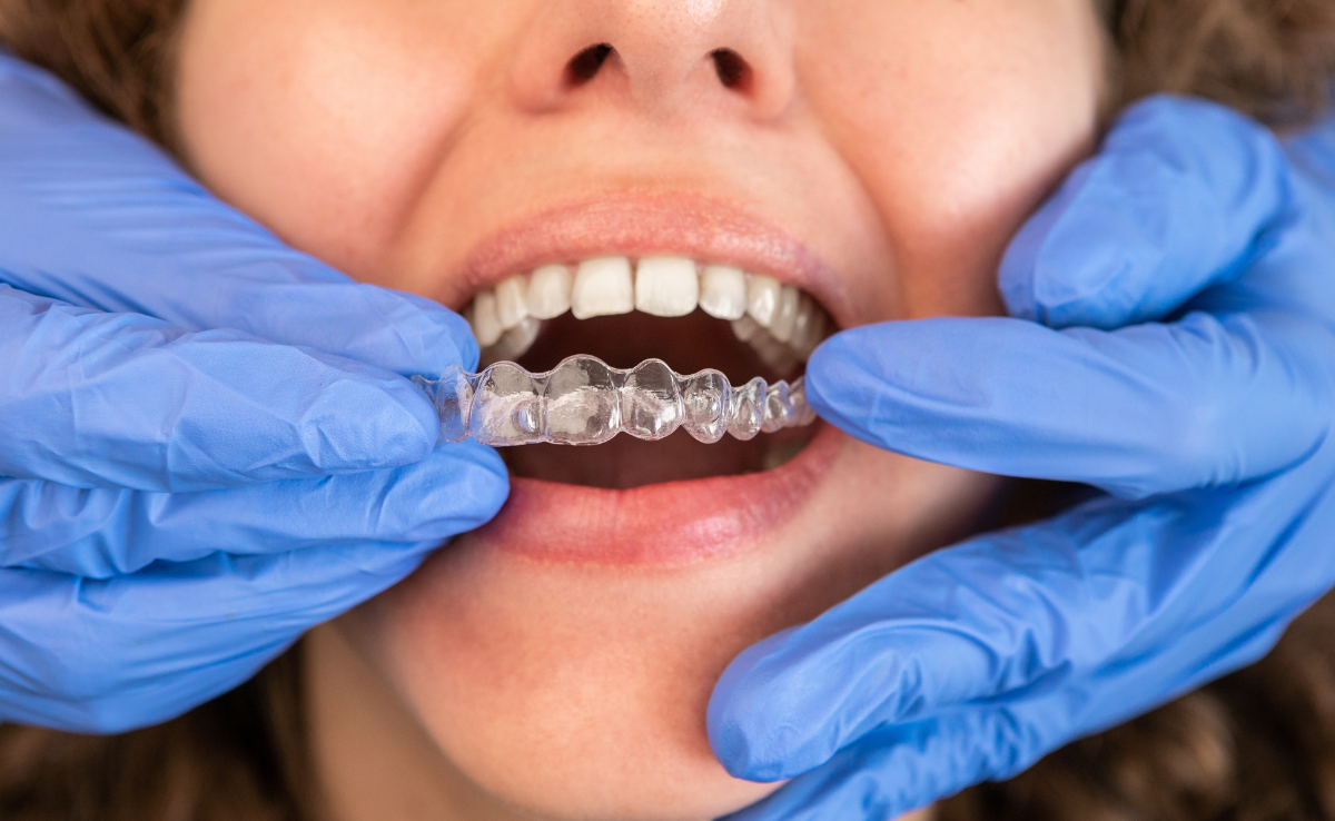 Invisalign retainer