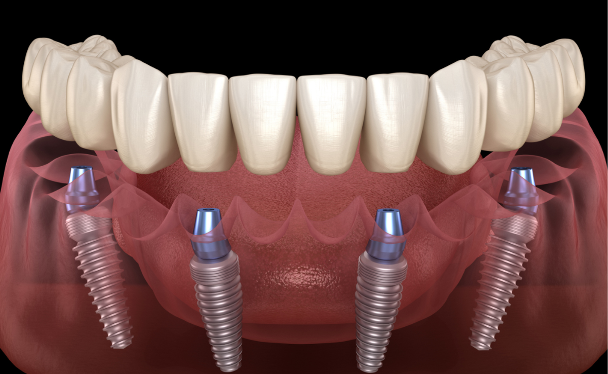 All on 4 Implan gigi