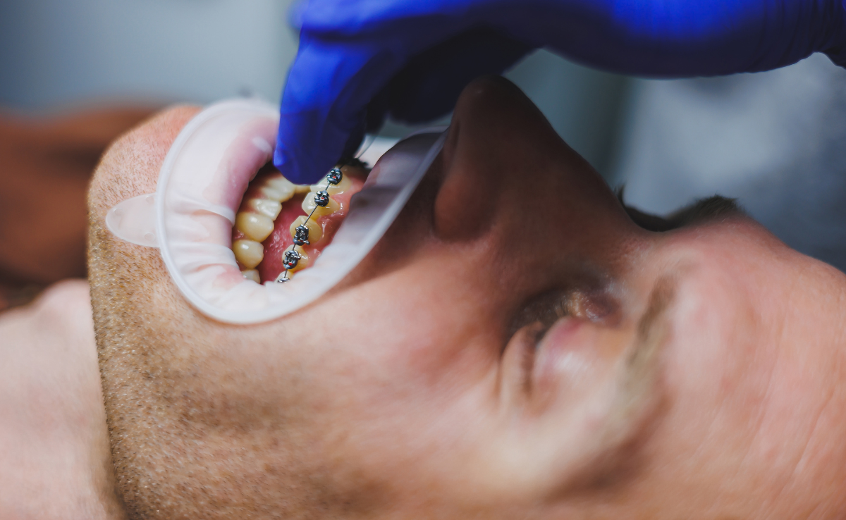 Rawatan braces untuk gigi jongang