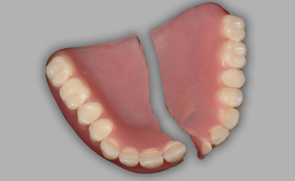 Cara Jaga Gigi Palsu Supaya Tahan Lama & Sentiasa Bersih 6 Gigi palsu pecah