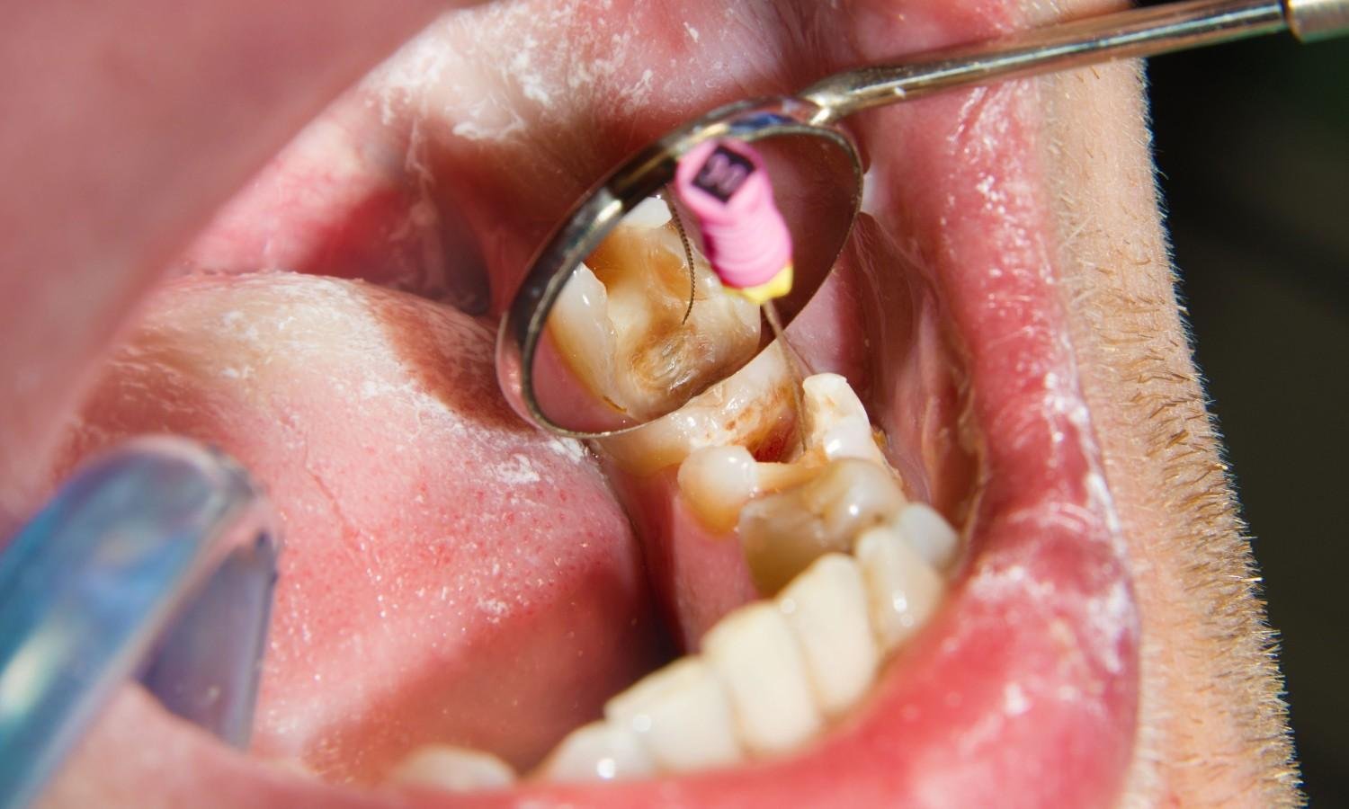 root canal