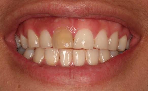 Tooth Discoloration