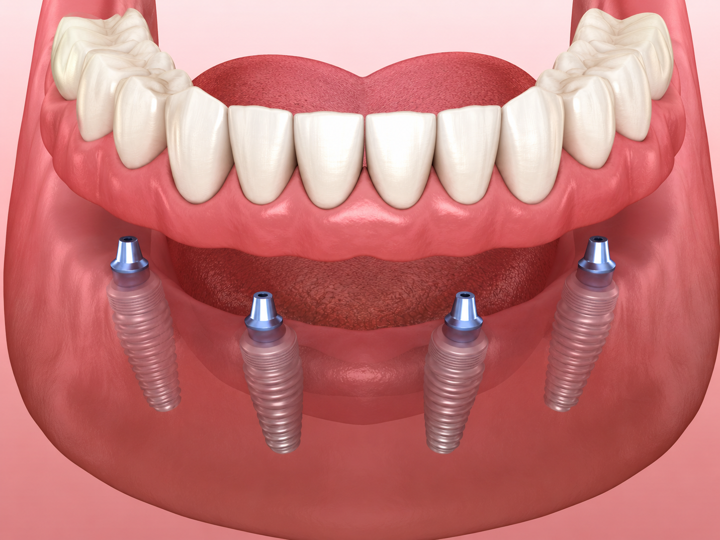 Denture Implants
